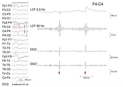 Exclusion of the Possibility of “False Ripples” From Ripple Band High-Frequency Oscillations Recorded From Scalp Electroencephalogram in Children With Epilepsy